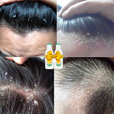 告別頭屑與瘙癢 如何選擇適合脂溢性頭皮的無硅油去螨洗發水